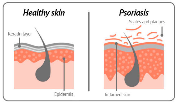 psoriasis skin en